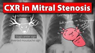 Chest X-ray (Part 3)  in Mitral Stenosis | Made easy