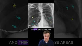 Emphysema on chest x-ray