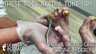 These Toes Need A Tune-up!! Nail & Callus Care for the Elderly