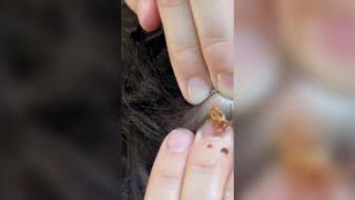 Popping huge blackheads and Pimple Popping - Best Pimple Popping Videos 75