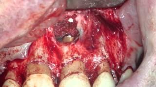 Anterior Periapical Surgery