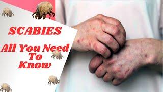 How To Identify & Treat Scabies: Causes, Symptoms, Prevention | Permethrin, Ivermectin