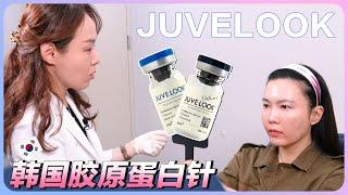 JUVELOOK胶原蛋白针，填充脸颊，太阳穴，八字纹的实际案例！(feat:特秀恩碧明洞店）