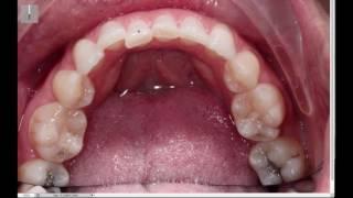 Upper and Lower Braces, 5 Visits with Bonding - Case Walkthrough