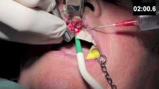 Dental Training - Implant surgery