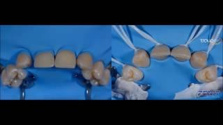 Zenit Nano Ceramic Composite ( President Dental Study Club)