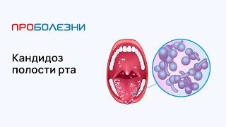 Кандидоз полости рта