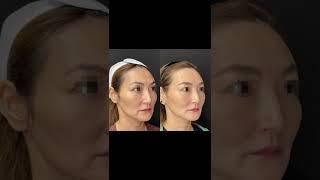 PDO Thread Invasive Nonsurgical Thread Face Lift Treatment - Ageless MD