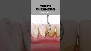 Teeth cleaning and polishing in Pimple Saudagar #dentist #punehealthcare #pimplesaudagar