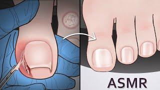 ASMR｜Ingrown Toenail and Corn removal treatment animation | 凍甲(甲溝炎＆雞眼治療動畫｜내성발톱&티눈 치료｜魚の目の芯を取る 巻き爪治療