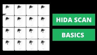 HIDA Scan Basics - Imaging of the Gallbladder