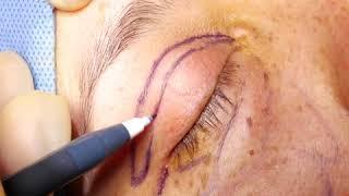 Eyelid Suturing | Upper Blepharoplasty | Kami Parsa, M.D. Beverly Hills Oculoplastic Surgeon