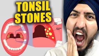 Do This to NEVER Get Tonsil Stones Again!