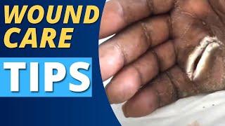 Cleaning an INFECTED Hand Wound | Wound Measuring & Evaluation Tips