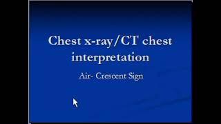 CT chest : Intracavitary aspergilloma ( by hammadshams)