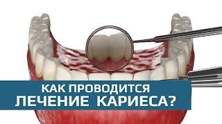 Лечение кариеса: этапы лечения кариеса