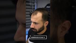 Hair Loss Types - Norwood Scale - Hair Transplant Turkey