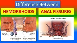 Treat Piles/Hemorrhoids and Anal fissure at Home:Urdu|Hindi#biology#science#pile#usmlesteps#usmlepre