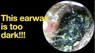 This earwax is too dark!!!|ear wax removal | ear cleaning | ASMR | relaxation | relax