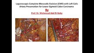 Laparoscopic CME with Left Colic Artery Preservation for Lower Sigmoid Colon Carcinoma