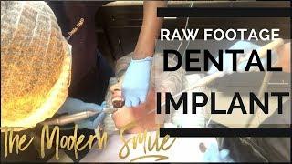 Dental Implant Surgery with Explanation of the Process