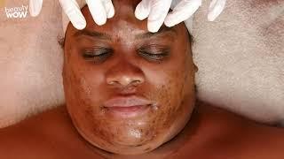 Extreme Facial to Get Rid of Acne and Pigmentation