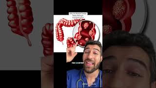 Why Are Bowel Cancer Rates Rising in Young People? #breakthrough