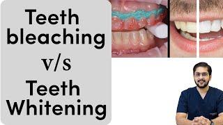 Teeth whitening v/s Teeth bleaching | दांत सुंदर सफेद करने का तरीका | Teeth white kaise karein