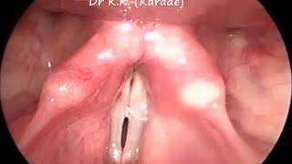 Laryngology : Sulcus Vocalis or Glottic Gap on Video Laryngoscopy