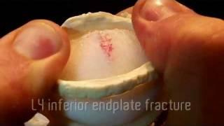 Disc Herniation and Endplate Fracture by Dynamic Disc Designs Corp.