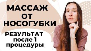 Удаление носогубных складок | Результат после 1-й процедуры!