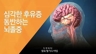 심각한 후유증 동반하는 뇌졸중 - (2015.11.18_562회 방송)_뇌졸중, 당신은 안전하십니까?