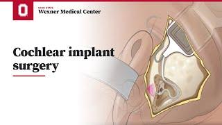 Cochlear implant surgery | Ohio State Medical Center