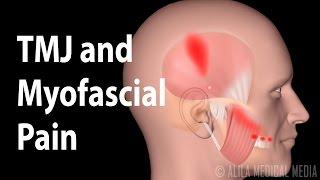 TMJ and  Myofascial Pain Syndrome, Animation.