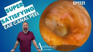 Deep Ear Wax & Skin Peel Removal! Unbelievable Extraction   EP1121