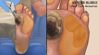 ASMR Treatment of severely hard and cracked feet | Calluses, Plantar Warts, Corn