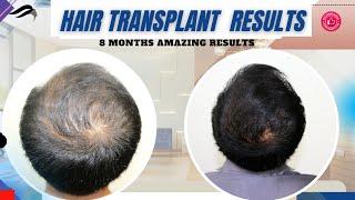 Hair Transplant In Hubli | Best Center Results Surgeon & Cost Of Hair Transplant In Hubli