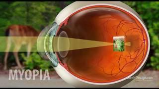 Myopia | Nearsightedness explained [HD]