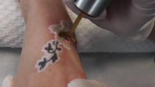 PicoWay Tattoo Removal