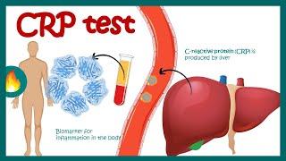 C-Reactive Protein (CRP) | Inflammation | Acute phase reactant | How do you read CRP test results?