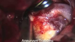 Direct suction decompression and fenestrated clip reconstruction of complex paraclinoid CA aneurysm
