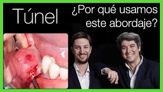 Abordaje en ️ TÚNEL en la [Técnica de Khoury] Implantes Dentales  - Formación Implantología‍