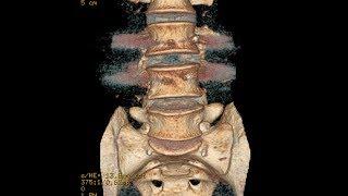 A Case of Double Failed Lumbar Fusion and Dangerously Misplaced Pedicle Screws