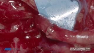 ARRISCOPE Application Video - Microvascular Anastomosis