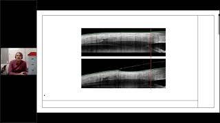 Annual Scleral Lens Society Research Update