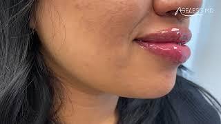 Pano - Lip filler treatment - Ageless MD