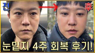 눈밑지방재배치 4주 리얼 후기 (feat. 붓기, 부작용 ,출혈)