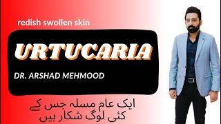 Urtucaria | Dr. Arshad Skin Specialist | Doctor