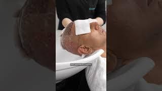 Hair Transplant Journey from Chicago to Turkey!