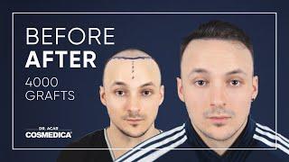 Excellent Before & After Hair Transplant with Dr. Acar